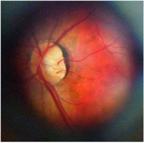 Retinal Photo