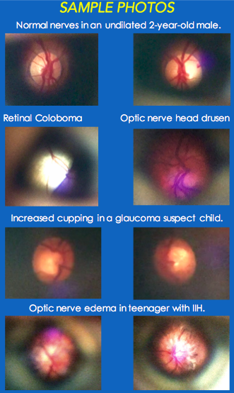 D-Eye Ophthalmoscope Pediatric Case Study