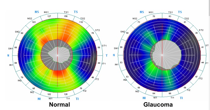 Optovue RTVUe 100 Glaucoma