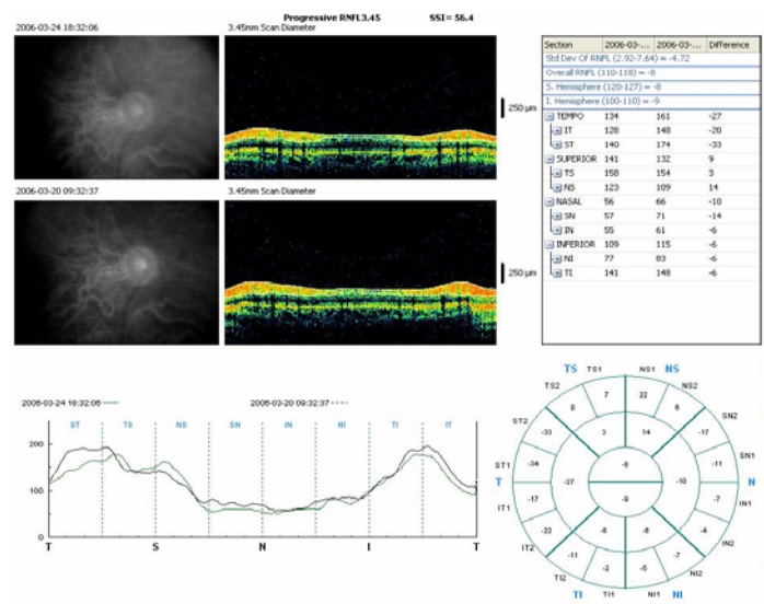 Optovue RTVue RNFL thickness