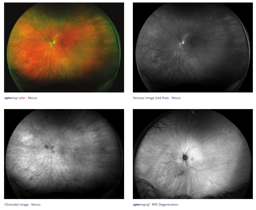 Optos Daytona Fundus