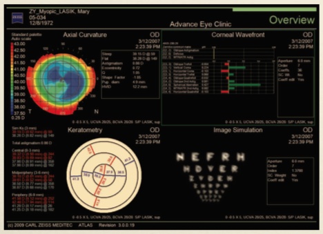 Zeiss Atlas - 9000 - Corneal Topographer Win 10 - Refurbished 22 Atlas 9000 3