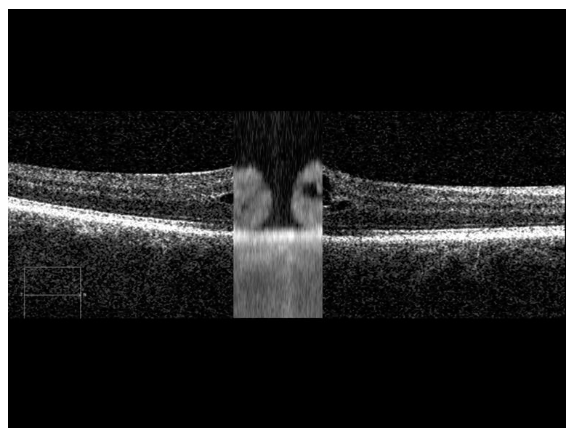 ZEISS IOLMaster - 700 - Refurbished 10 Zeiss IOLMaster 700 retina visualization — macular OCT scan for fixation check