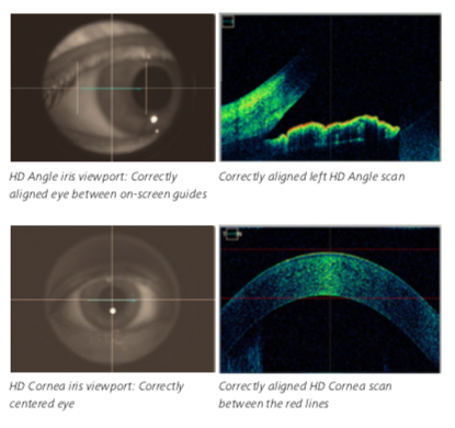 Zeiss Optional Anterior Segment Premier Lenses for Cirrus 4000, 500, 5000, 6000 - Refurbished 4 Zeiss Cirrus anterior segment scan acquisition interface — anterior chamber view