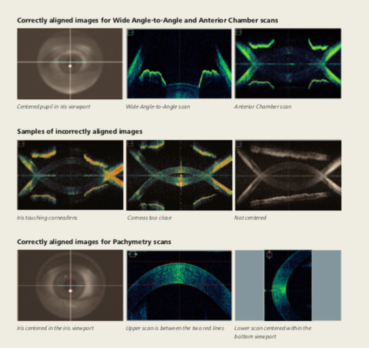 Zeiss Optional Anterior Segment Premier Lenses for Cirrus 4000, 500, 5000, 6000 - Refurbished 6 Zeiss Cirrus anterior segment corneal vertex centering — vertical reflex alignment